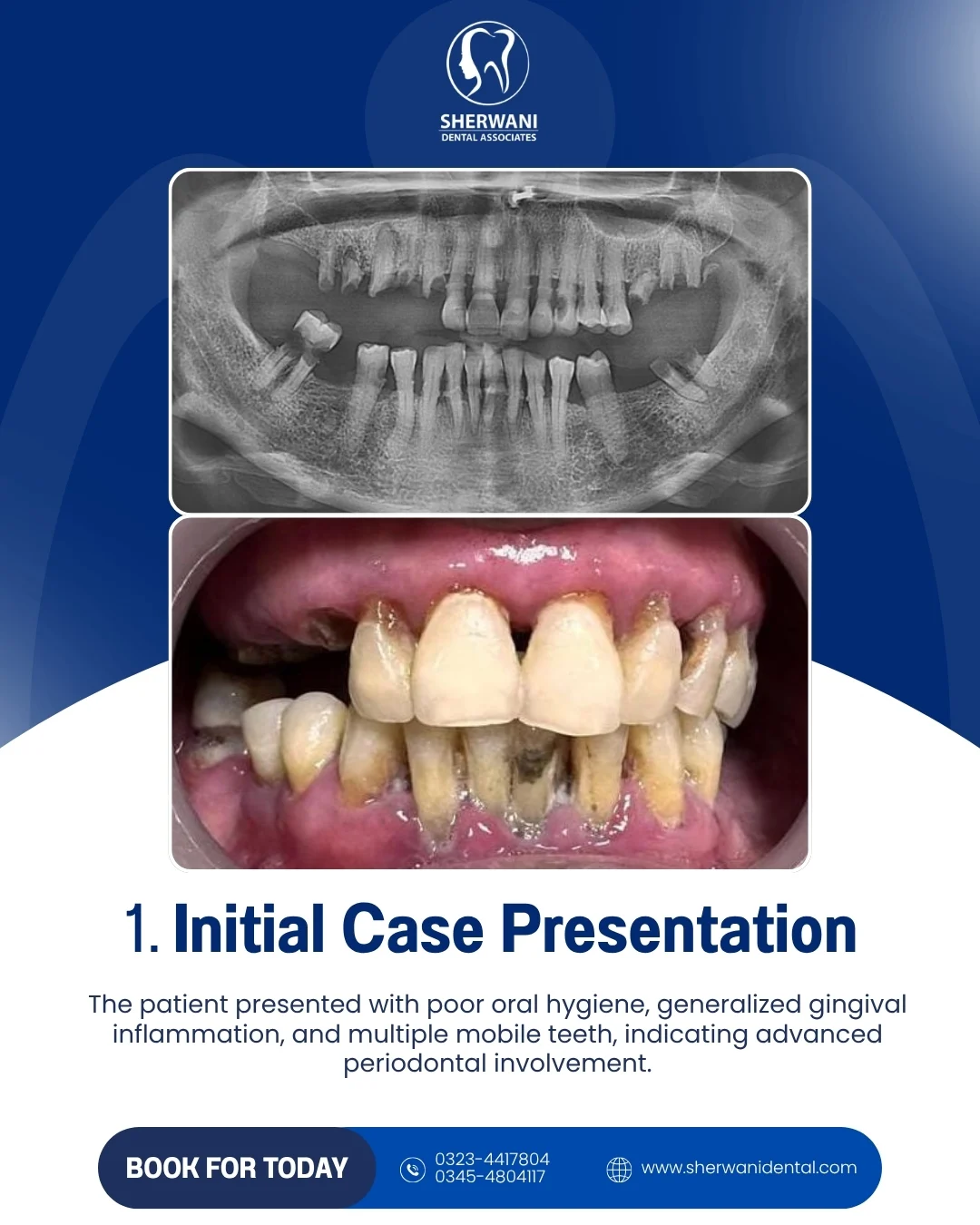 Initial full-mouth rehabilitation case presentation