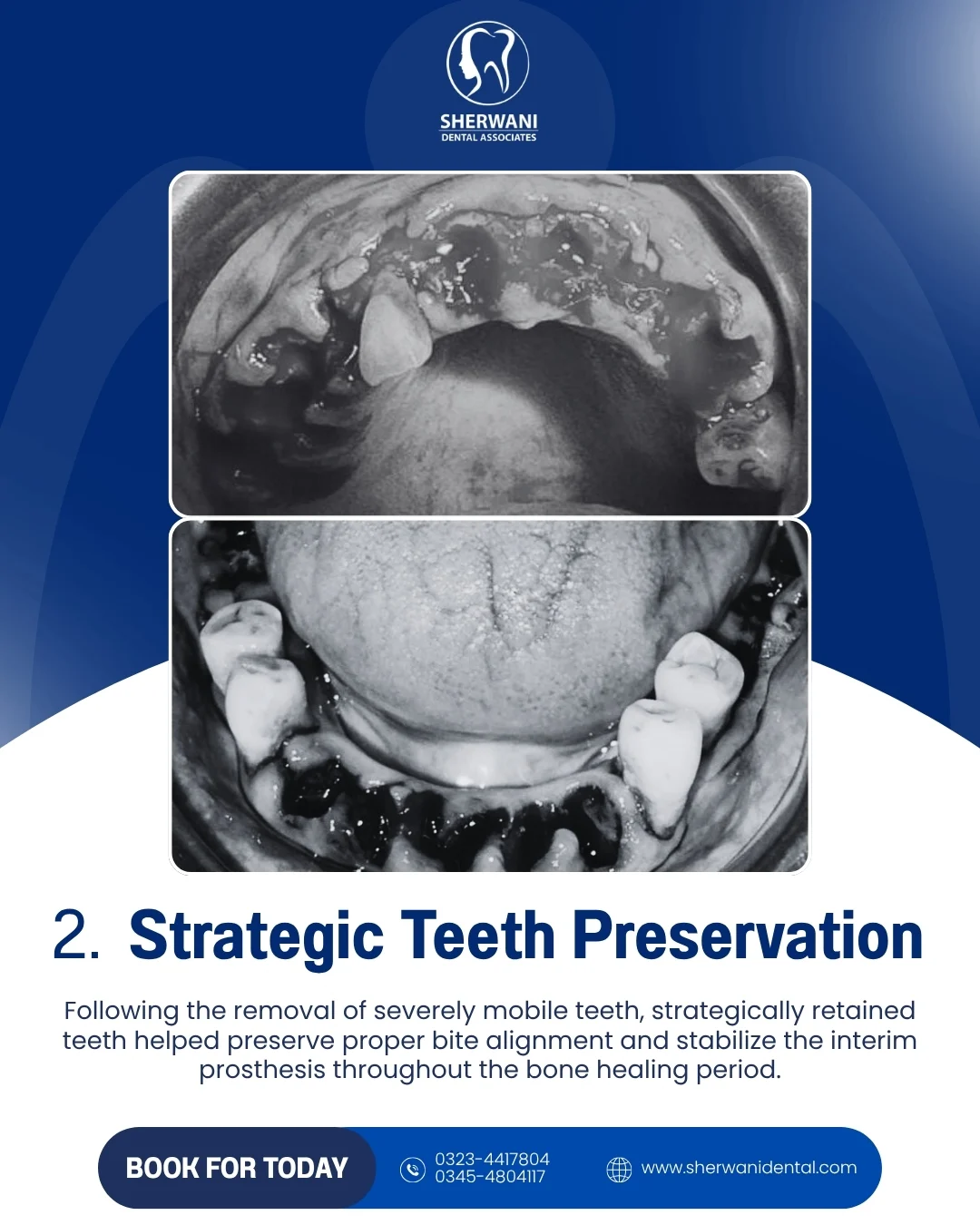 Strategic teeth preservation stage