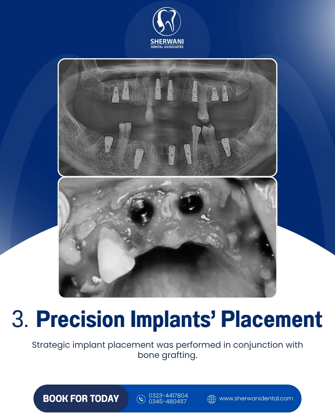 Precision implant placement stage