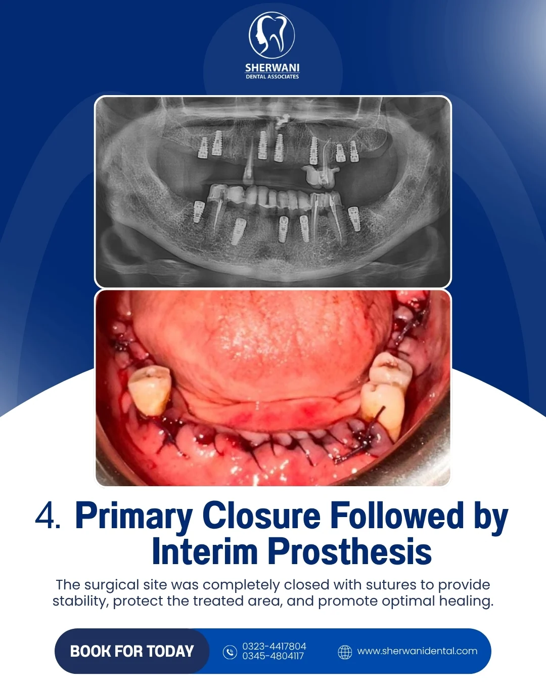 Primary closure and interim prosthesis stage