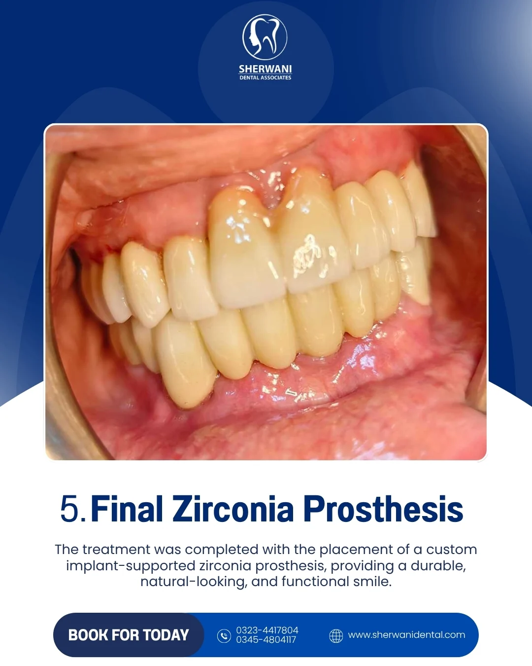 Final zirconia prosthesis result